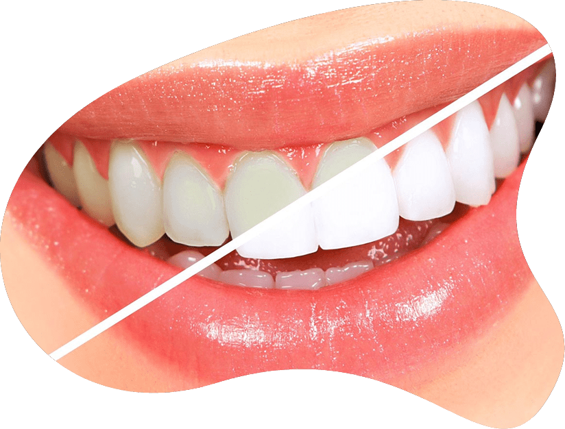 Diş beyazlatma