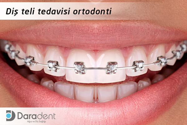 dis-teli-tedavisi Diş teli tedavisi ortodonti